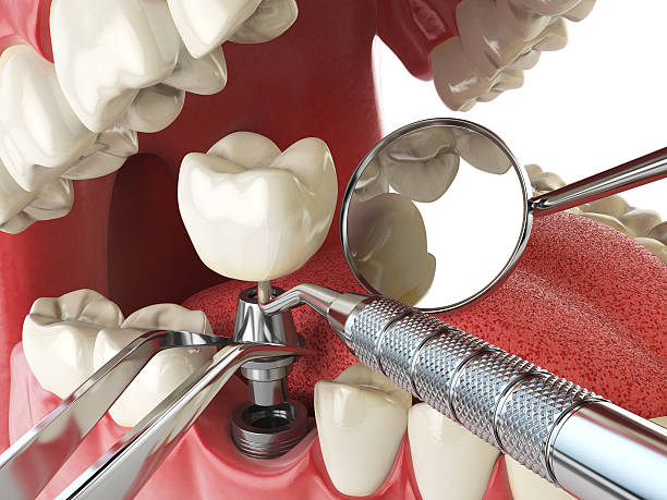 Best Emergency Dental Care for Broken or Chipped Teeth in Morenci, AZ